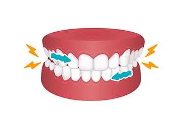 食いしばりのダメージの軽減
