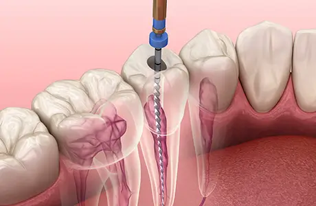 重度の虫歯でも歯を残せる根管治療
