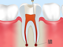 重度の虫歯には根管治療を行います