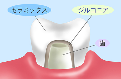 ジルコニアセラミック